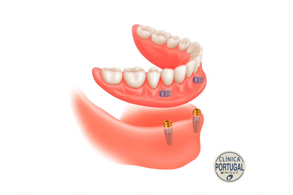 sobredentadura sobre implantes