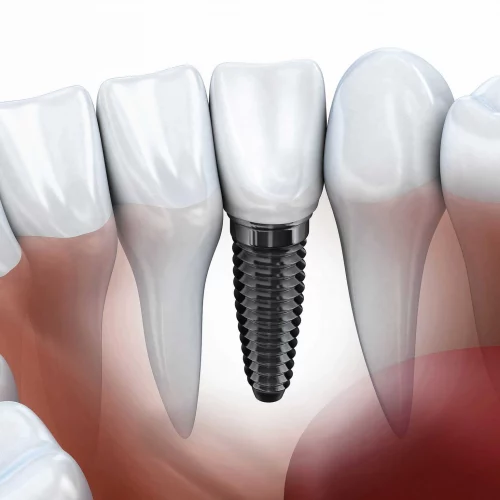 Implante dental en Arcos